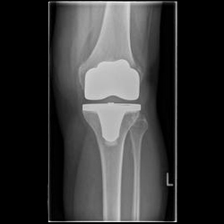 Knieprothese Röntgenbild